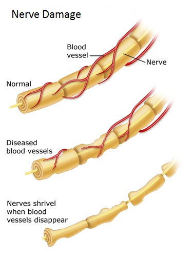 nerve damage phases
