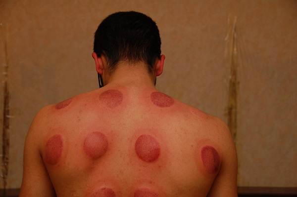 cupping is an ancient technique 